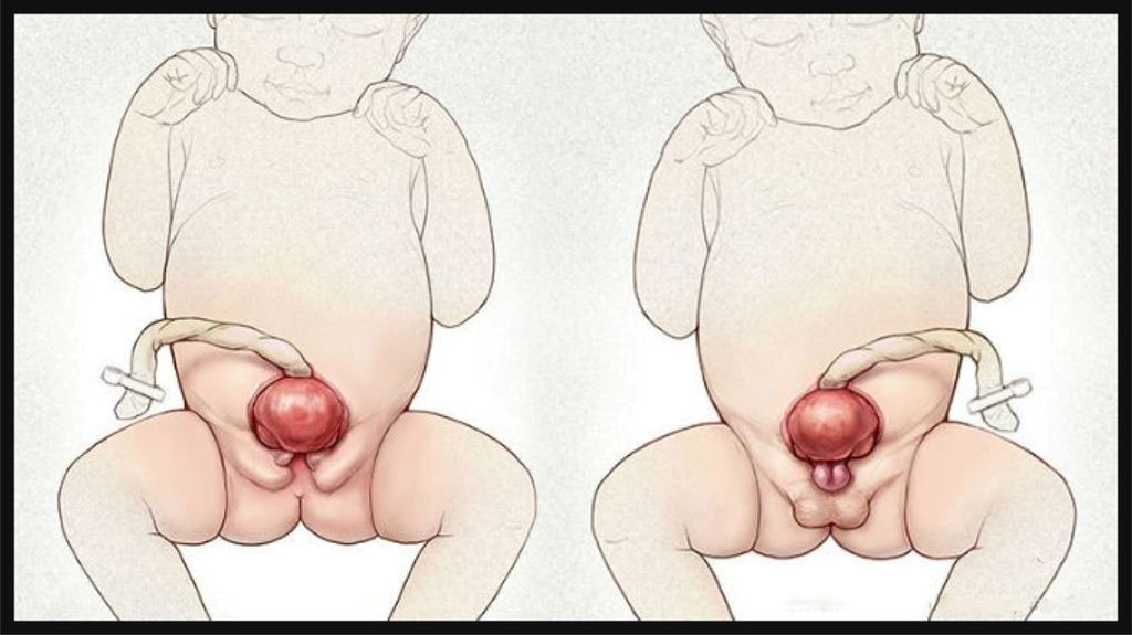 Bladder Exstrophy Diagnosis